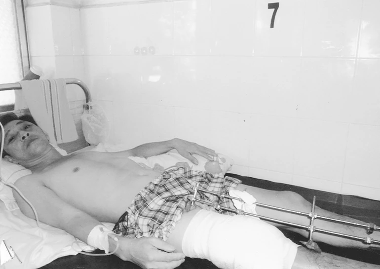 Anh Lê Phước Hưng bị tai nạn lao động